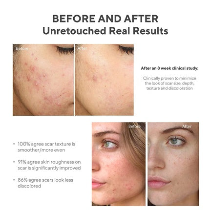 Murad InvisiScar Resurfacing Treatment, 30 ml