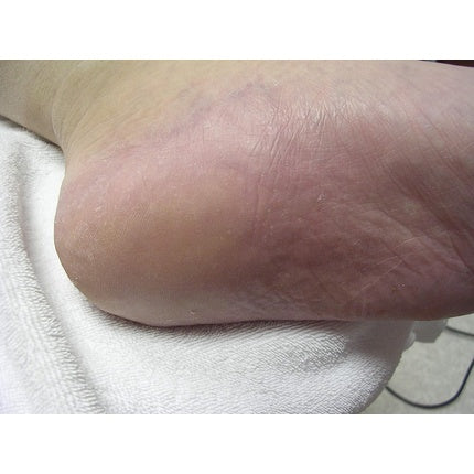 Cremă pentru picioare, Footlogix, Cracked Heel Formula, alb