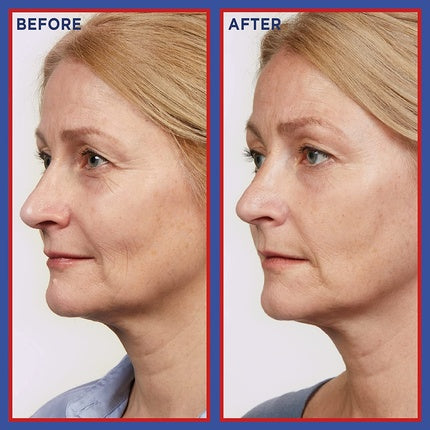 Ser anti-îmbătrânire, L'Oréal, Revitalift Laser, albastru, 30ml