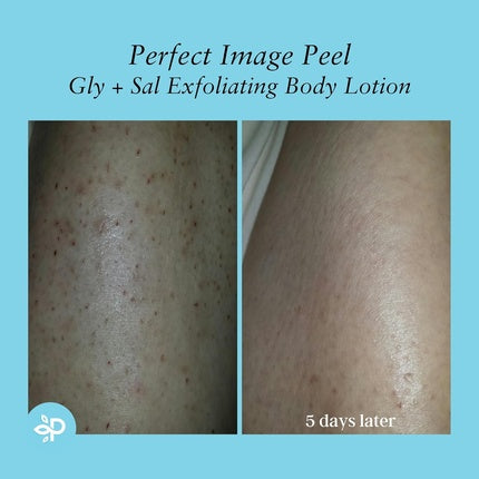 Lichid exfoliant pentru corp, Perfect Image, Gly 10 Sal 2, 300 ml