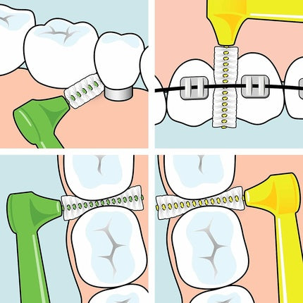 Periute interdentare, Tepe, Angle, set mixt